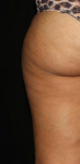 Coolsculpting to Inner & Outer Thighs Before